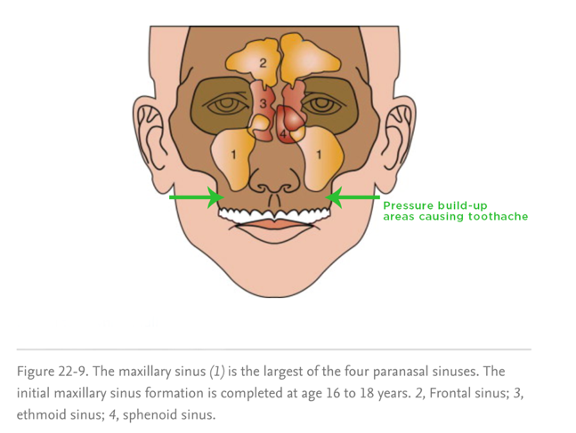 The maxillary sinus is made up of a right sinus and a left sinus.